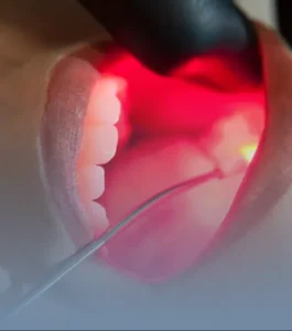 Laser de baixa intensidade, consultório da Dra. Carolina Vivan em Pinheiros